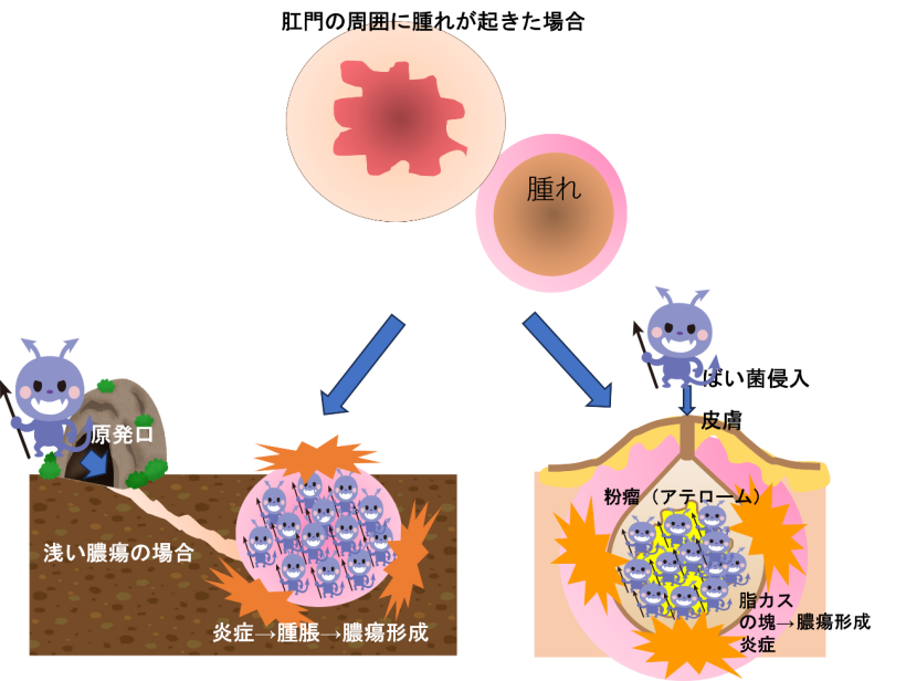 化膿性汗腺炎