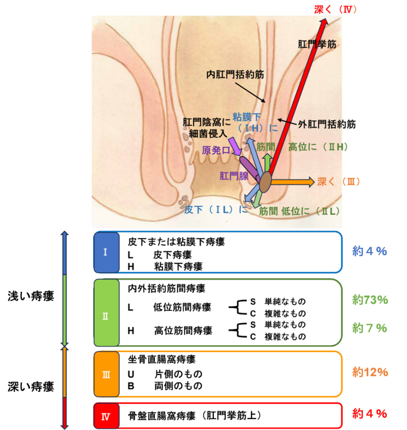 痔瘻の分類