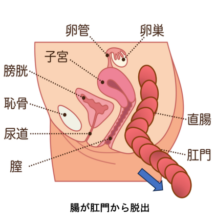 直腸脱