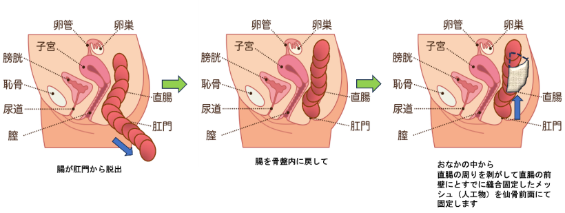 『経腹的直腸つり上げ固定法』