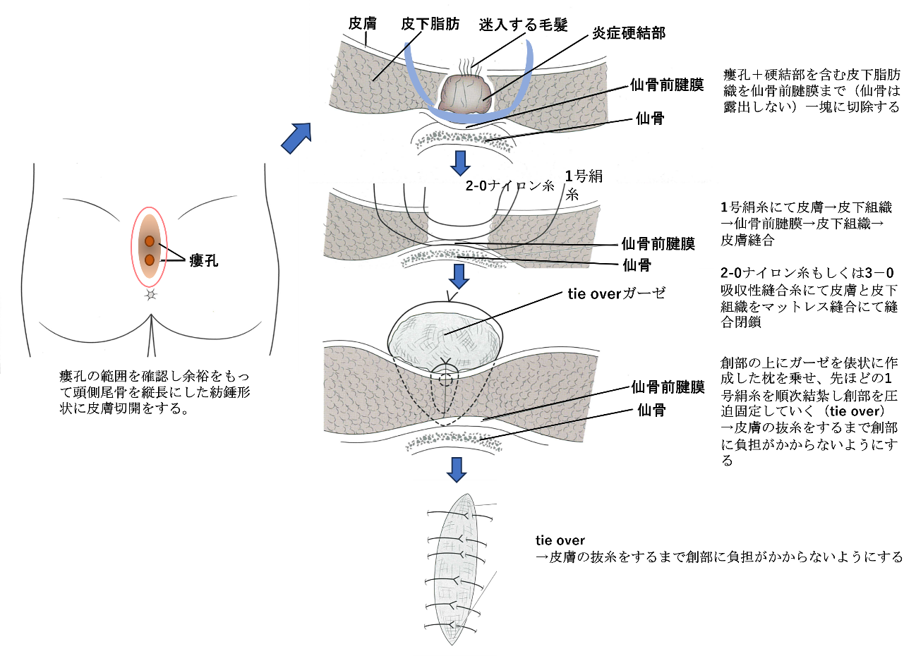 『毛巣洞　もうそうどう　（毛巣瘻）　もうそうろう』