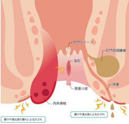 『痔』のことを理解するには