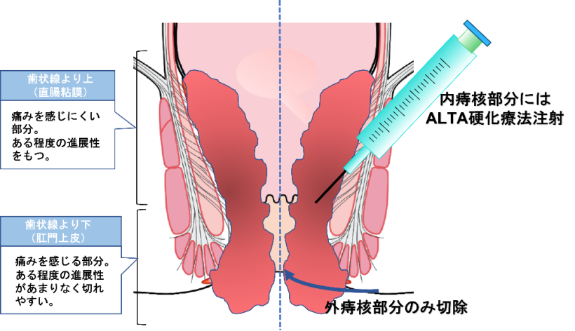 （肛門管外）の外痔核部分のみ切除し、内痔核部分に硬化療法（ALTA療法）を注射する方法