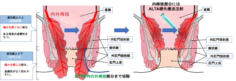 （肛門管内）までの外痔核部分を切除し、内痔核部分に硬化療法（ALTA療法）を注射する方法