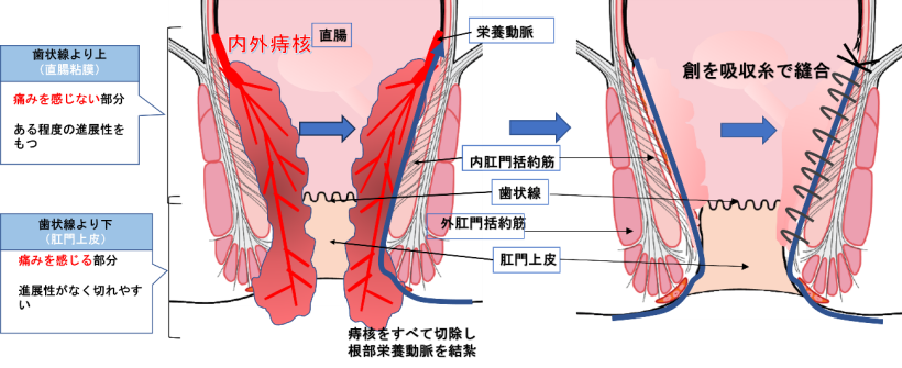 入院手術