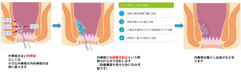 腰椎麻酔下で施行するALTA（ジオン®）単独療法