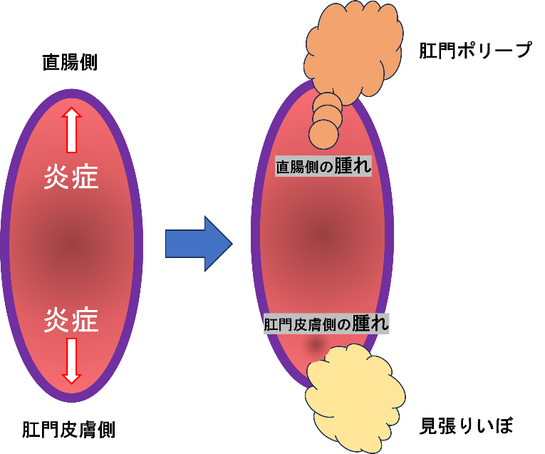 炎症性ポリープ