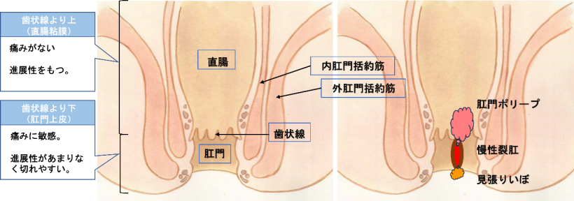 いぼ痔