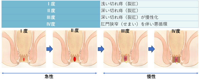 肛門狭窄