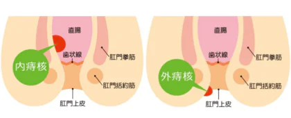 『いぼ痔（痔核）』の手術をしたのに、またしばらく経って最近また肛門が痛くなることがあります。再発しちゃったのでしょうか？