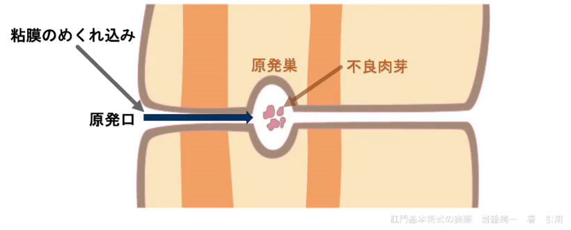 『あな痔（痔瘻）』手術の実際