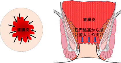 『あな痔（痔瘻）』と関連する腸の病気