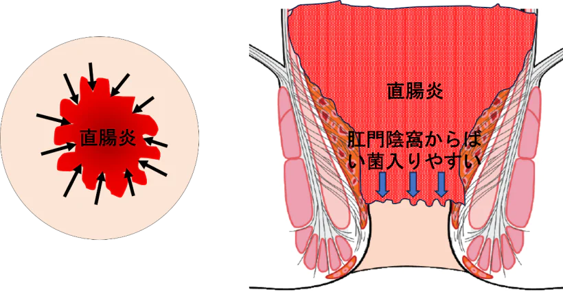 『あな痔（痔瘻）』と関連する腸の病気