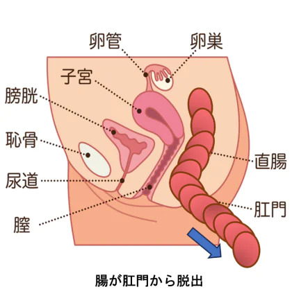 『直腸脱（ちょくちょうだつ）』