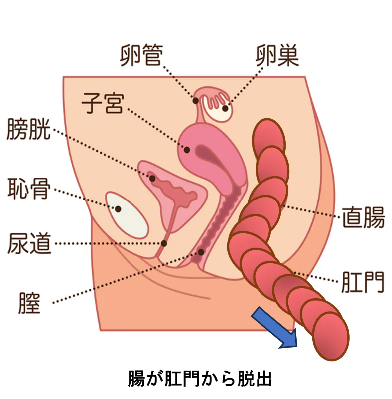 『直腸脱（ちょくちょうだつ）』