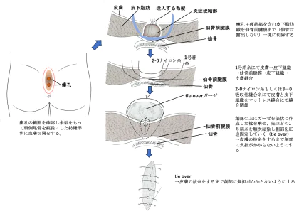 『毛巣洞（もうそうどう）毛巣瘻（もうそうろう）』