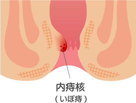いぼ痔（内痔核）