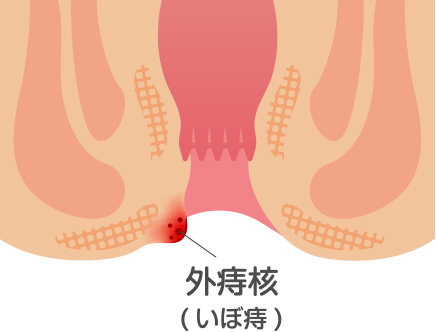 いぼ痔（外痔核）