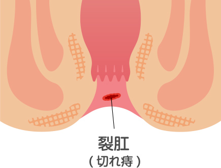 切れ痔（裂肛）