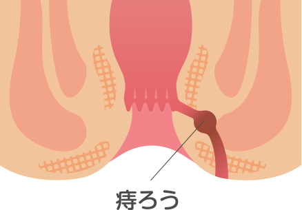 痔ろう（穴痔）