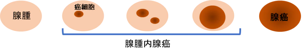 大腸ポリープ切除|東京都足立区扇大橋・西新井の内科・外科・胃腸内科・整形外科、寺田病院