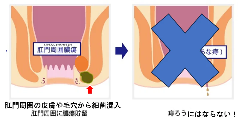 肛門皮膚からの細菌混入（アテロームや毛嚢炎）が肛門周囲にできた場合